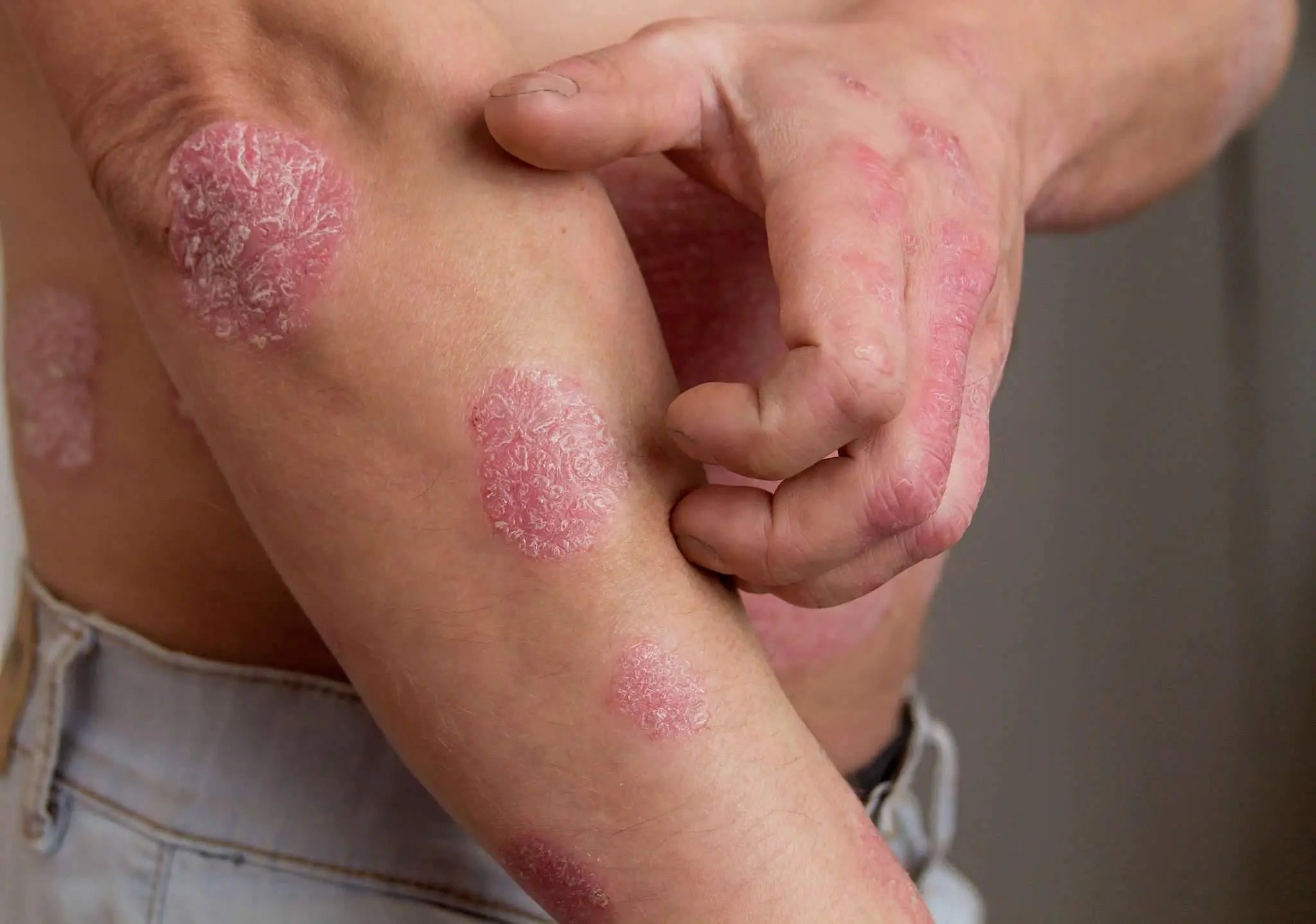 Can CBD Help Treat Psoriasis - Herbaleyes