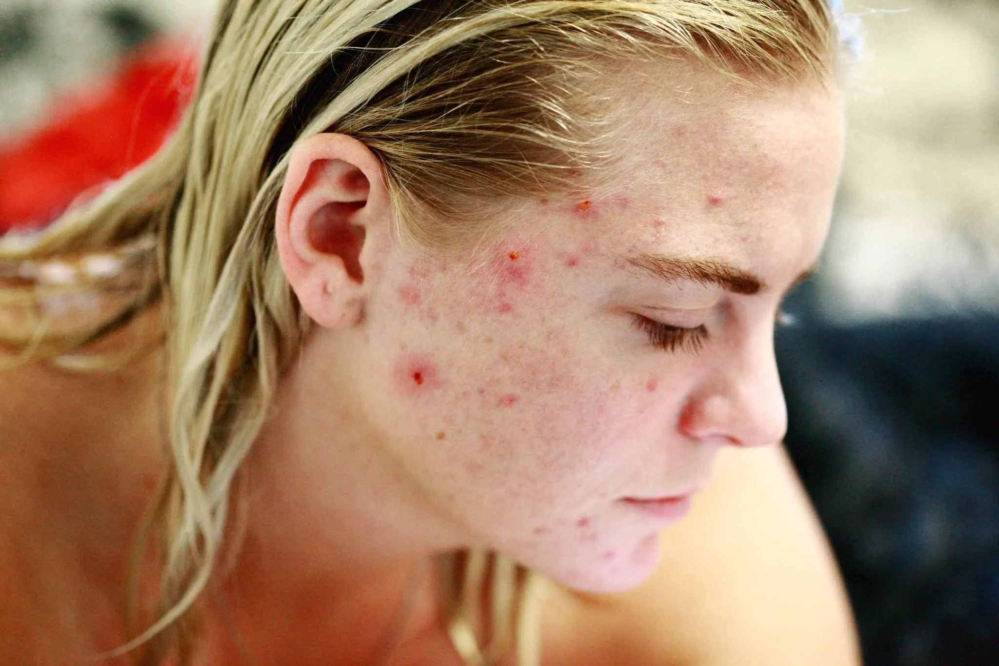 Can CBD Treat Acne? - Herbaleyes